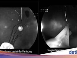 Detik-detik Praktisi Medis Senior FKUI Keluarkan Jarum Pentul Bersama Lambung