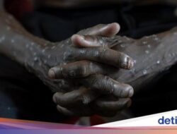 Makin Ngeri, Kematian Mpox ‘Cacar Monyet’ Di Afrika Sudah Lebih Untuk 800 Perkara Hukum Hukum