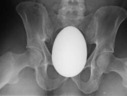 Hasil Foto X-Ray yang Bikin Geleng-geleng, Temuan Benda Aneh 'Nyangkut' Hingga Anus