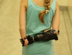 Ternyata Pasien Amputasi Masih Bisa Rasakan Anggota Tubuh yang Hilang