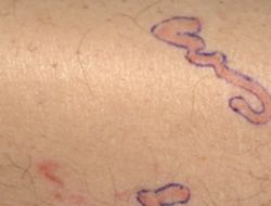 Merinding! Potret Tubuh Ruam Merah, Ternyata Ada Cacing ‘Merayap’ Hingga Bawah Kulit