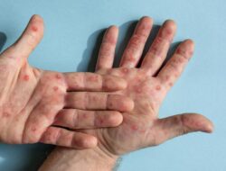 Praktisi Medis Ungkap Pemicu Orang Dewasa Rentan Kena Campak Tanda-Tanda Berat